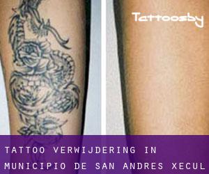 Tattoo verwijdering in Municipio de San Andrés Xecul