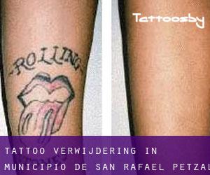 Tattoo verwijdering in Municipio de San Rafael Petzal