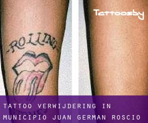 Tattoo verwijdering in Municipio Juan Germán Roscio