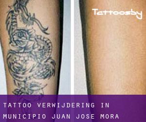 Tattoo verwijdering in Municipio Juan José Mora