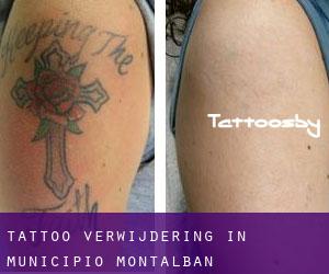 Tattoo verwijdering in Municipio Montalbán