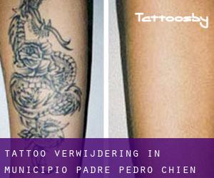 Tattoo verwijdering in Municipio Padre Pedro Chien