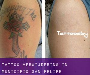 Tattoo verwijdering in Municipio San Felipe