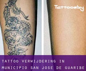 Tattoo verwijdering in Municipio San José de Guaribe