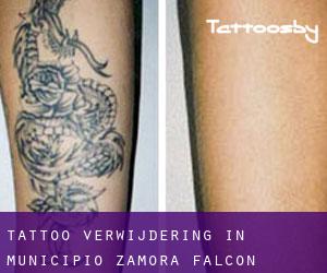 Tattoo verwijdering in Municipio Zamora (Falcón)