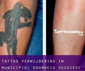 Tattoo verwijdering in Municipiul Odorheiu Secuiesc