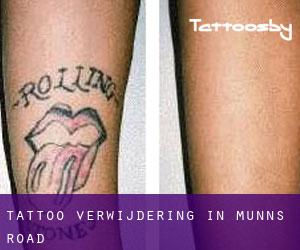 Tattoo verwijdering in Munns Road