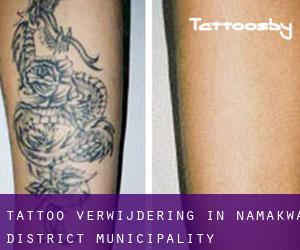 Tattoo verwijdering in Namakwa District Municipality