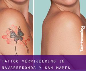 Tattoo verwijdering in Navarredonda y San Mamés