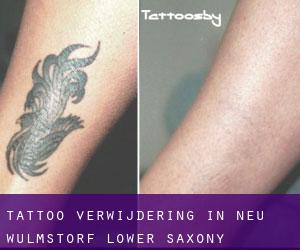 Tattoo verwijdering in Neu Wulmstorf (Lower Saxony)