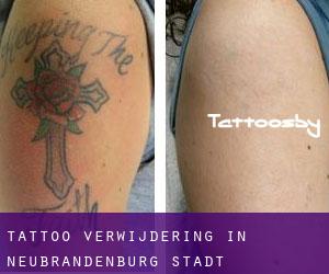 Tattoo verwijdering in Neubrandenburg Stadt