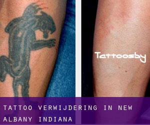 Tattoo verwijdering in New Albany (Indiana)