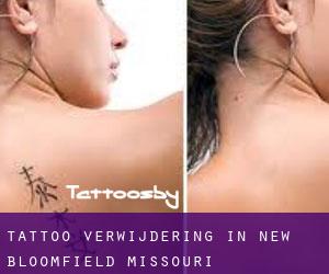 Tattoo verwijdering in New Bloomfield (Missouri)
