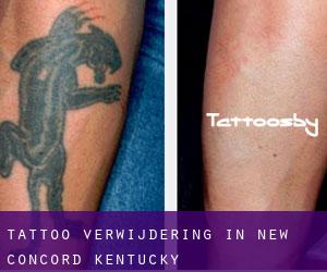 Tattoo verwijdering in New Concord (Kentucky)