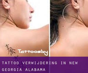 Tattoo verwijdering in New Georgia (Alabama)