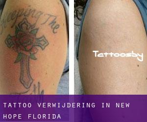 Tattoo verwijdering in New Hope (Florida)