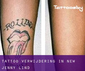 Tattoo verwijdering in New Jenny Lind
