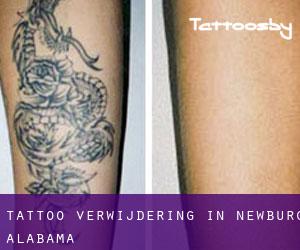 Tattoo verwijdering in Newburg (Alabama)