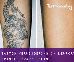 Tattoo verwijdering in Newport (Prince Edward Island)