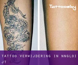 Tattoo verwijdering in Nāngloi Jāt