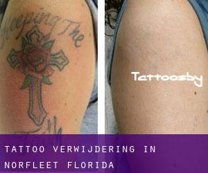 Tattoo verwijdering in Norfleet (Florida)
