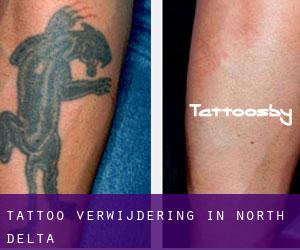 Tattoo verwijdering in North Delta
