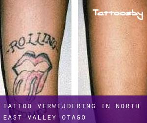 Tattoo verwijdering in North East Valley (Otago)