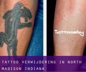 Tattoo verwijdering in North Madison (Indiana)