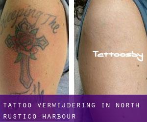 Tattoo verwijdering in North Rustico Harbour