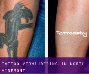 Tattoo verwijdering in North Vinemont