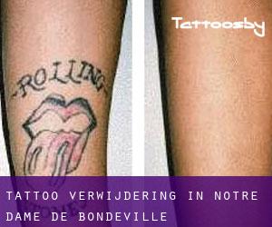 Tattoo verwijdering in Notre-Dame-de-Bondeville