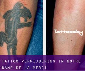 Tattoo verwijdering in Notre-Dame-de-la-Merci
