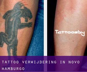 Tattoo verwijdering in Novo Hamburgo