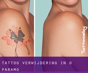 Tattoo verwijdering in O Páramo