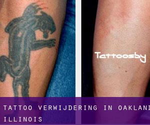 Tattoo verwijdering in Oakland (Illinois)