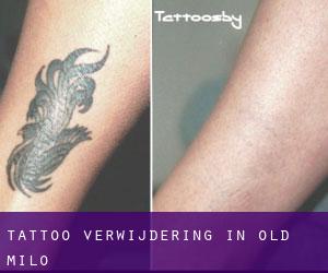 Tattoo verwijdering in Old Milo