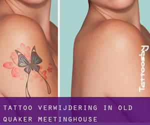 Tattoo verwijdering in Old Quaker Meetinghouse