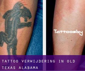 Tattoo verwijdering in Old Texas (Alabama)