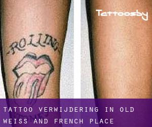 Tattoo verwijdering in Old Weiss and French Place