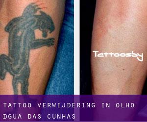 Tattoo verwijdering in Olho d'Água das Cunhãs