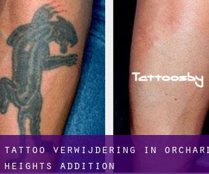Tattoo verwijdering in Orchard Heights Addition