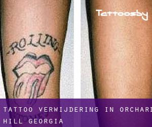 Tattoo verwijdering in Orchard Hill (Georgia)