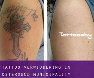 Tattoo verwijdering in Östersund municipality