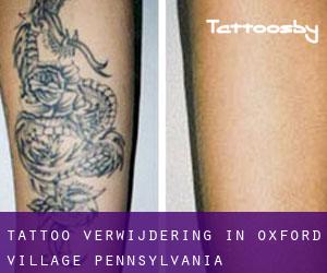 Tattoo verwijdering in Oxford Village (Pennsylvania)