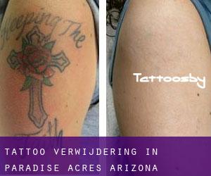 Tattoo verwijdering in Paradise Acres (Arizona)