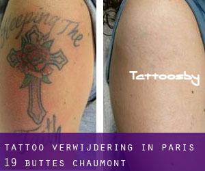 Tattoo verwijdering in Paris 19 Buttes-Chaumont