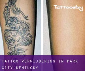 Tattoo verwijdering in Park City (Kentucky)
