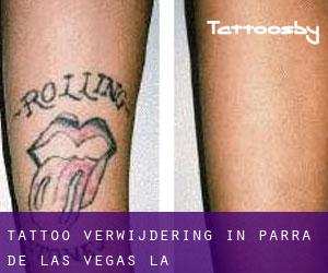 Tattoo verwijdering in Parra de las Vegas (La)