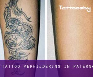 Tattoo verwijdering in Paterna