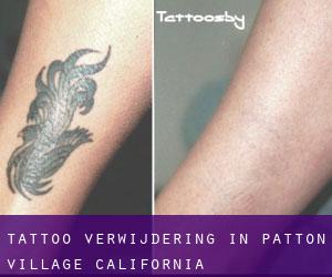 Tattoo verwijdering in Patton Village (California)
